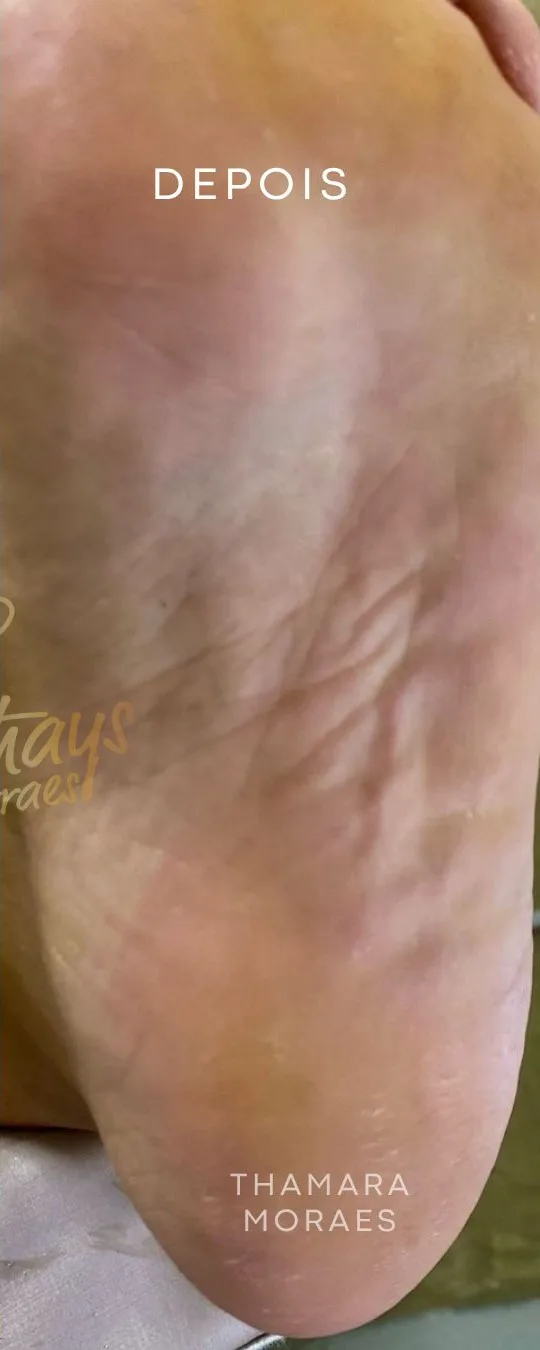 Depois — tratamento de rachaduras e ressecamento plantar