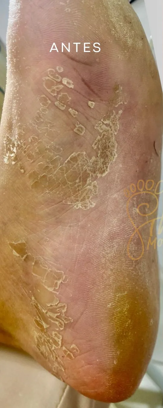 Antes — tratamento de rachaduras e ressecamento plantar