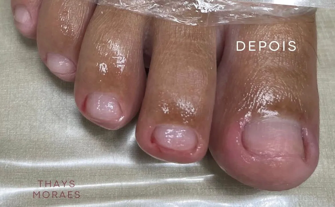 Depois — tratamento de onicomicose em várias unhas
