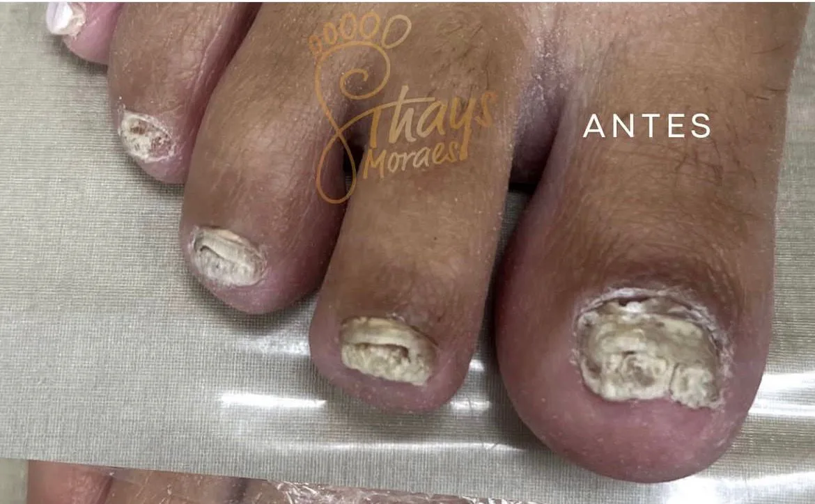 Antes — tratamento de onicomicose em várias unhas